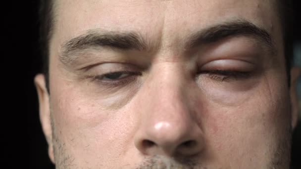 Közelkép az ember súlyos véraláfutásos vörös vér szem érinti kötőhártya-gyulladás — Stock videók