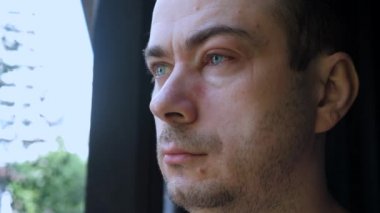 Alerjiden sonra gözlerinde konjonktivit enfeksiyonu olan erkek hasta.