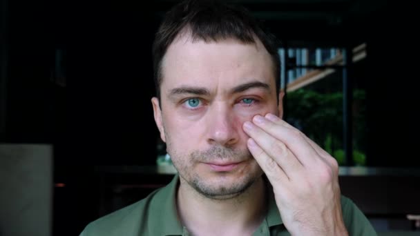 Smutný muž Dotek po ruce jedno oteklé infikované oko s příznakem zánětu spojivek — Stock video