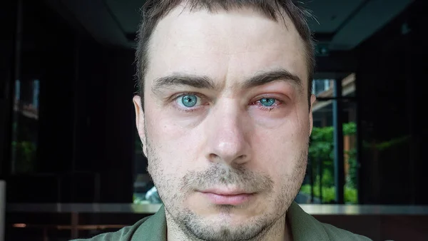 Porträtt av människan med svullet öga, lider av konjunktivit — Stockfoto