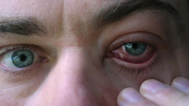Крупный план человека с больным, раздраженным, инфицированным, воспалительным глазом — стоковое видео