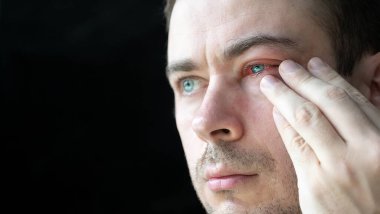 Üzgün Adam Kanlı Gözüne Dokun Conjunctivitis Etkisi Altında