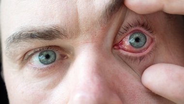 Doktor, göz iltihabı olan kırmızı gözlü bir erkeğe bakıyor.