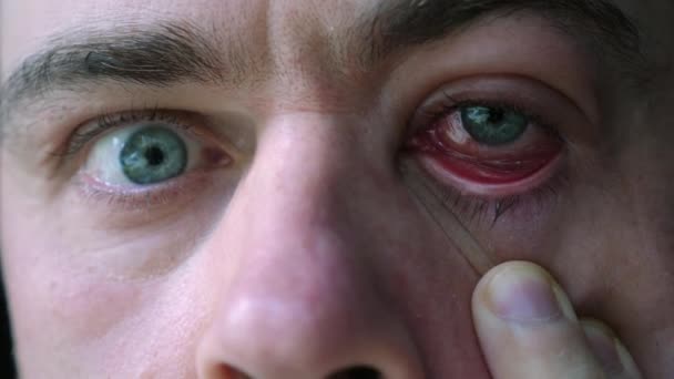 Arzt betrachtet männlichen Patienten mit roten entzündeten Augen mit Bindehautentzündung — Stockvideo