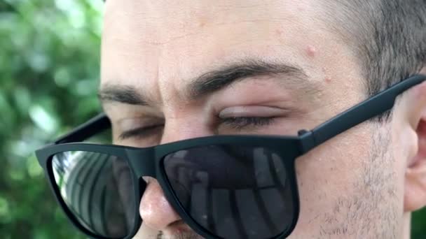 Muž se zánětlivou a ovlivněnou konjunktivitidou Oko se dívá přes brýle — Stock video