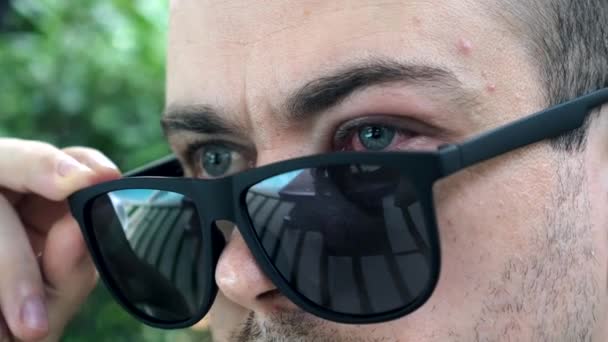 Hombre con alergias lleva gafas de sol oscuras, ocultando ojo lesionado después de picadura de insecto — Vídeo de stock