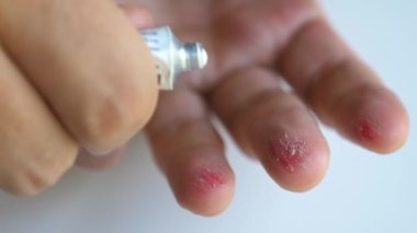 Adam cildini çizmiş. Elindeki yara iyileştirici kremle iyileşmiş. Erkek kol merhemi sürerken yaralı parmaklarına krem ya da jöle sıkın. Yetişkin hastaların tedavisi, kızarıklık, deri yaraları..