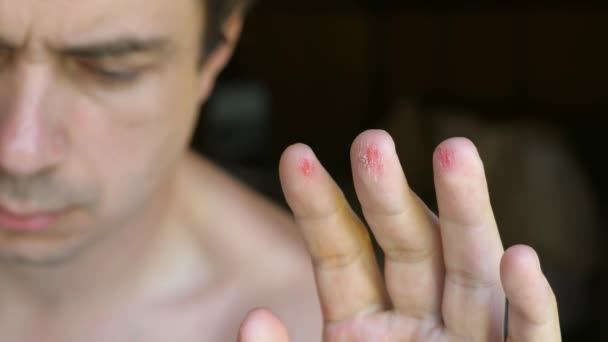 Smutný Nešťastný Muž Trpí Bolestí Kvůli Zraněným Prstům Ruce Čerstvě — Stock video