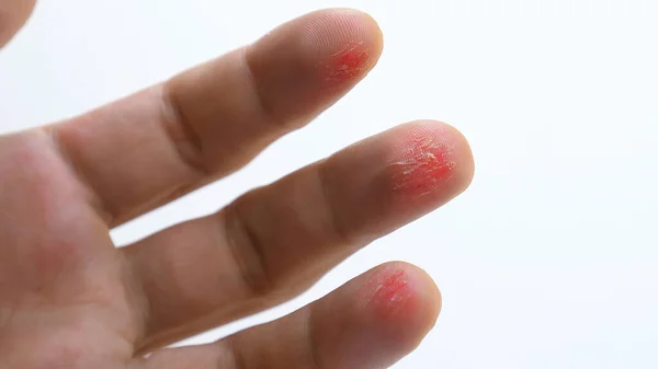 Injured fingers of man hand. Scratched skin wound on fingers. Damaged hurt male arm. Small fresh cuts on fingers on white background. Concept of hard heavy manual work. Close-up.