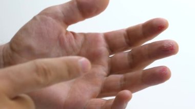 Damaged male arm. Scratched skin bloody wound on fingers with inflammation. Man palm hand with injured fingers. Fresh red cuts on fingers on white background. Concept of hard manual work. Close-up.