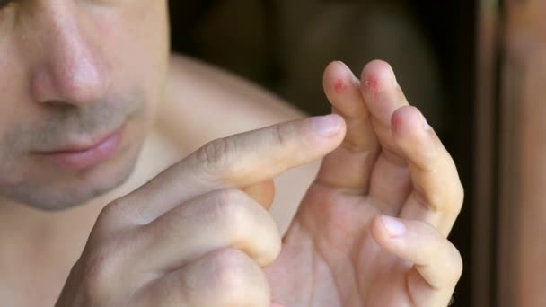 Sad Unhappy Man Suffering Pain Touching His Injured Fingers Hand — Stock videók