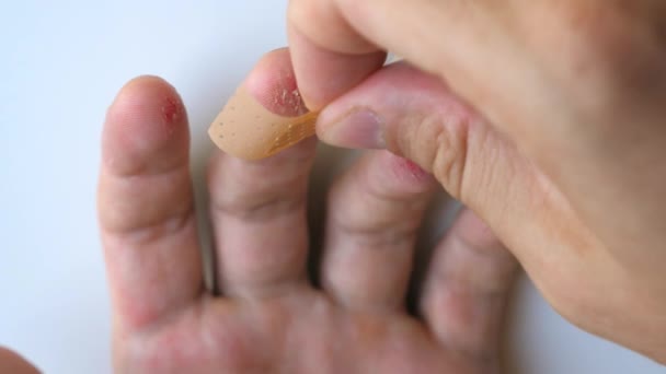 Männchen Legt Medizinisches Klebeband Auf Verletzte Wunde Finger Das Gips — Stockvideo
