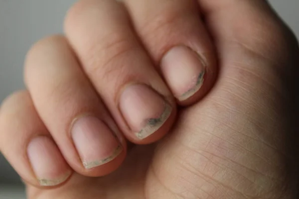 Manikürsüz hasarlı çivi. Toprak yakın plan. Çivi Sağlık Hizmetleri.