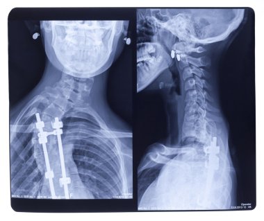 X-ray, Scoliosis clipart