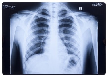 X-ray, Human Chest clipart