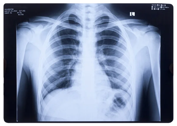 X-ray, menselijke borst — Stok fotoğraf