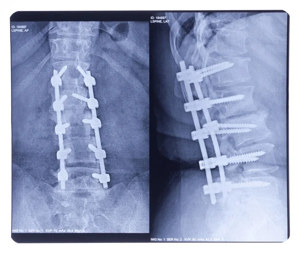 脊柱侧凸、 x 射线 — 图库照片