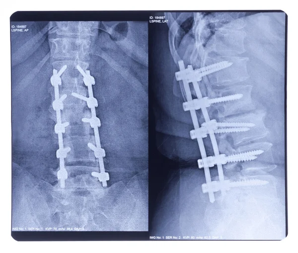 Scoliose, radiographie — Photo