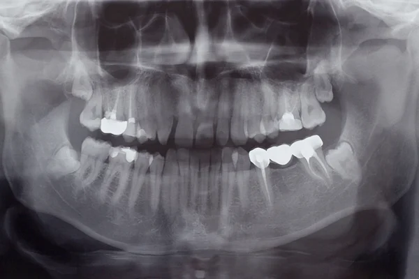 Menselijke tanden, x-ray — Stockfoto