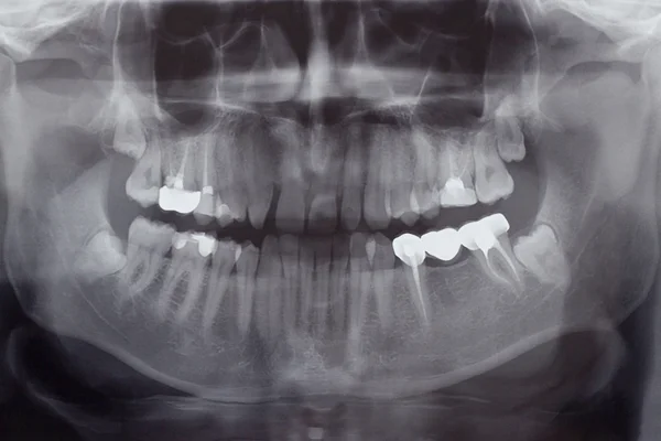 Människans tänder, röntgen Stockfoto