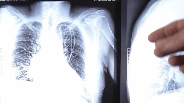 Médecin examinant l'image radiographique de la poitrine humaine 