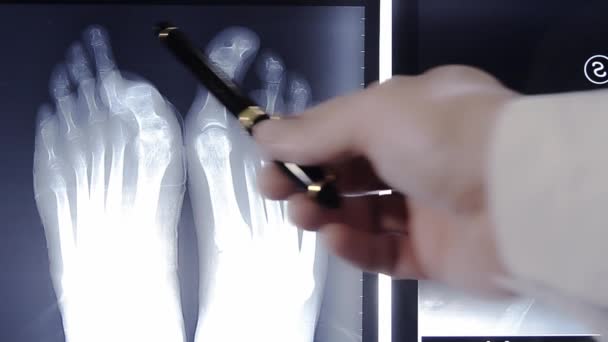 Доктор вивчає пальці ніг, виставлені на рентгенівській плівці — стокове відео