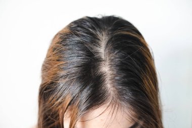 Saçında kepek, kafasında kafa derisi olan Asyalı bir kadın.