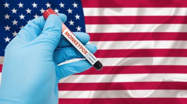 hand holding blood collection tubes on monkeypox virus test positive results with United States - USA flag. clipart