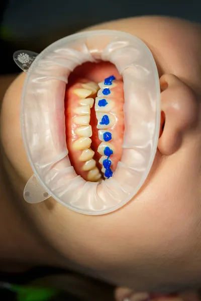 歯医者は患者の歯に金属のブレースを置きます 歯列矯正治療 高品質の写真 — ストック写真