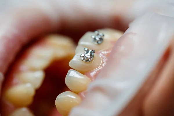 Ortodonta Zakłada Metalowy Aparat Zęby Pacjenta Ortodontyczne Leczenie Stomatologiczne Wysokiej — Zdjęcie stockowe