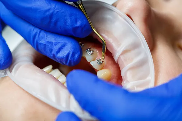 歯医者は患者の歯に金属のブレースを置きます 歯列矯正治療 高品質の写真 — ストック写真
