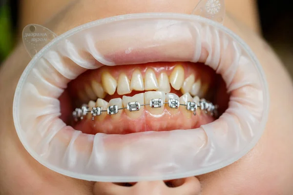 Diş Tellerinin Takılması Ortodontik Diş Tedavisi Diş Telleriyle Yakın Plan — Stok fotoğraf