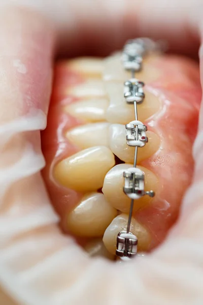 歯にブレースのインストール 歯列矯正治療 ブレースで歯を閉じてください 高品質の写真 — ストック写真