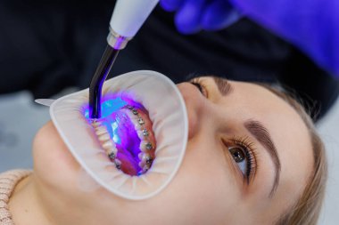 Klinikte metal diş telli bir kadının dişleri tedavi ediliyor. Bir ortodontist dişlerine diş teli takmak için diş aletleri kullanır. Seçici odak