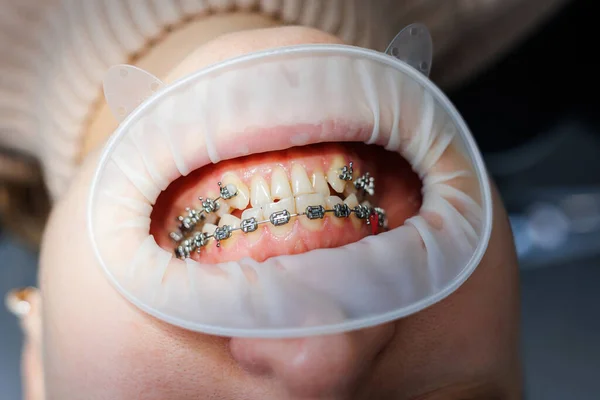 金属製のブレースで口と歯のクローズアップ 歯列矯正歯科治療 — ストック写真
