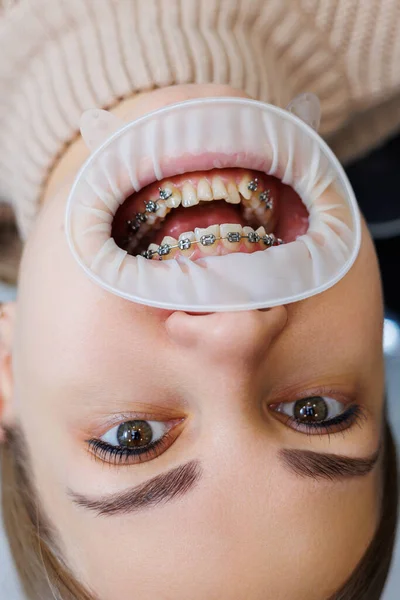 Nahaufnahme Von Mund Und Zähnen Mit Metallspangen Kieferorthopädische Zahnbehandlung — Stockfoto