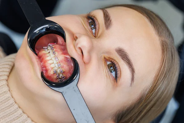 Zbliżenie Ust Zębów Metalowymi Szelkami Ortodontyczne Leczenie Stomatologiczne — Zdjęcie stockowe