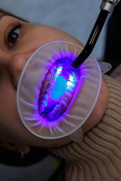 Klinice Leczą Zęby Kobiety Metalowymi Aparatami Zęby Ortodonta Używa Narzędzi — Zdjęcie stockowe
