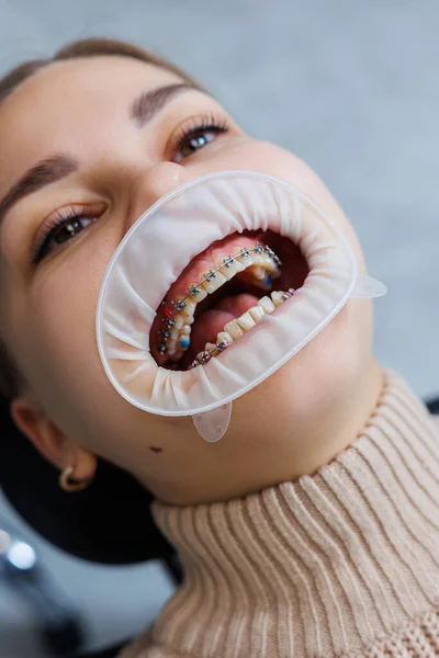 Gros Plan Bouche Des Dents Avec Appareil Dentaire Métal Traitement — Photo