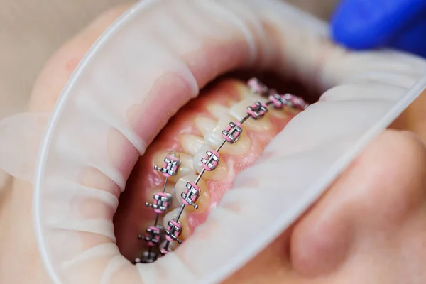 Κοντινό πλάνο του στόματος και των δοντιών με μεταλλικά στηρίγματα. Ορθοδοντική οδοντική θεραπεία — Φωτογραφία Αρχείου
