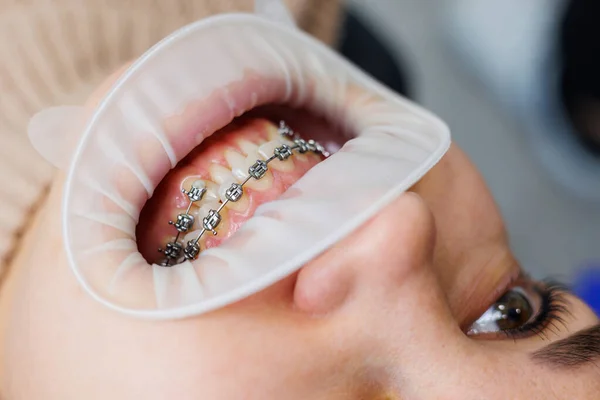 Ağız Diş Telleriyle Yakın Plan Ortodontik Diş Tedavisi — Stok fotoğraf