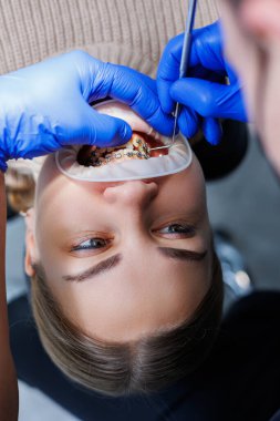 Klinikte metal diş telli bir kadının dişleri tedavi ediliyor. Bir ortodontist dişlerine diş teli takmak için diş aletleri kullanır. Seçici odak