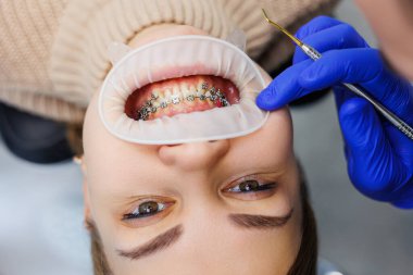 Klinikte metal diş telli bir kadının dişleri tedavi ediliyor. Bir ortodontist dişlerine diş teli takmak için diş aletleri kullanır. Seçici odak