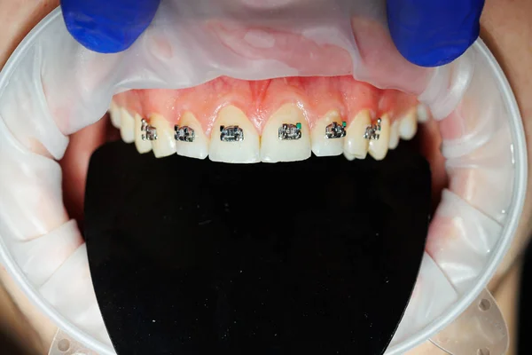 歯を伸ばせ 歯医者の予約でブレースを持つ女性の歯 歯の歪みの矯正治療 クローズアップ 選択的フォーカス 歯の上の歯の歯 — ストック写真