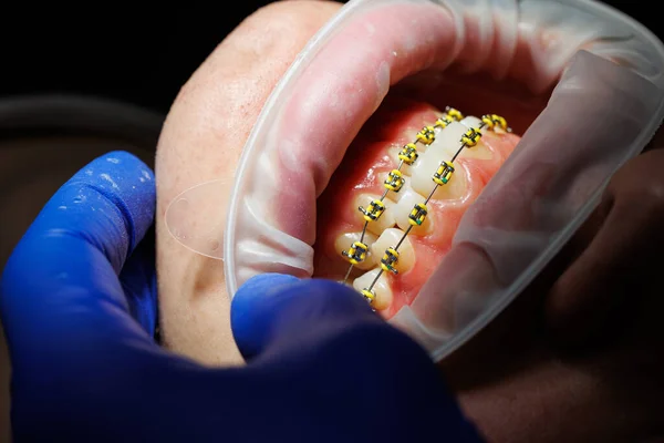 Przedłużacz Zębów Zęby Kobiety Aparatem Zębach Dentysty Leczenie Ortodontyczne Zaburzeń — Zdjęcie stockowe