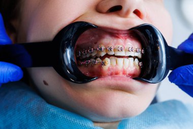 Diş uzatıcısı. Diş hekiminde diş teli takan bir kadının dişleri. Diş bozulmasının ortodontik tedavisi. Yakın plan, seçici odaklanma. Diş telleri.