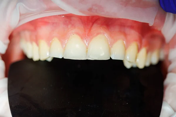 歯の閉鎖 歯科事務所での歯の検査 歯医者は患者の歯を歯科器具で検査する 選択的焦点 — ストック写真