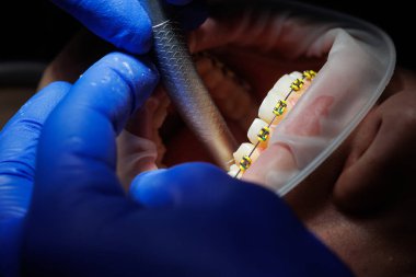 Diş uzatıcısı. Diş hekiminde diş teli takan bir kadının dişleri. Diş bozulmasının ortodontik tedavisi. Yakın plan, seçici odaklanma. Diş telleri.