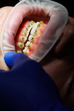 Diş uzatıcısı. Diş hekiminde diş teli takan bir kadının dişleri. Diş bozulmasının ortodontik tedavisi. Yakın plan, seçici odaklanma. Diş telleri.