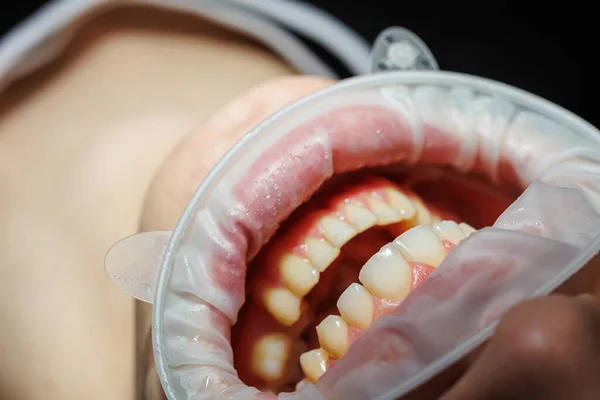 Κοντινό Πλάνο Δοντιών Οδοντιατρικό Τσεκ Στο Οδοντιατρείο Οδοντίατρος Εξετάζει Δόντια — Φωτογραφία Αρχείου